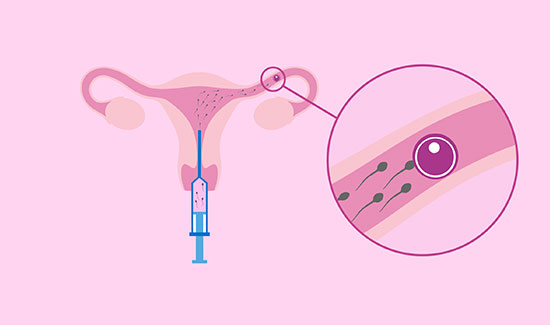Artificial Insemination In Bangalore at Miracle Ivf Hospital 