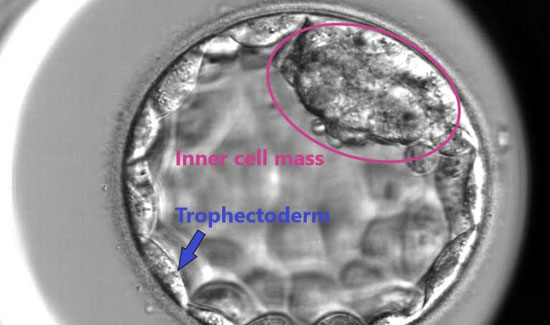 Blastocyst Culture at IVF Hospital in Bangalore at Miracle Ivf Hospital 