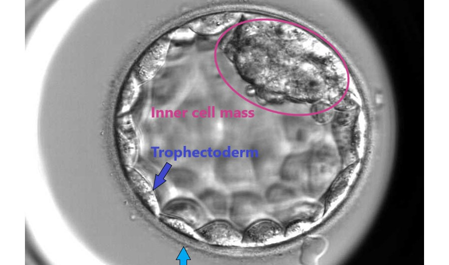 Blastocyst Culture at Miracle IVF Hospital, Bangalore.