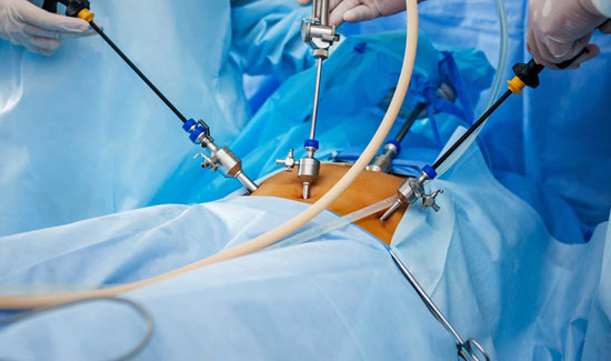 Gynaecological Endoscopy in Bangalore at Miracle Ivf Hospital 