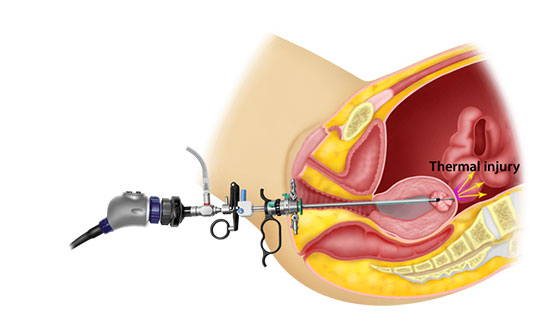 Hysteroscopy Procedure for Fertility Diagnosis in Bangalore at Miracle Ivf Hospital 

