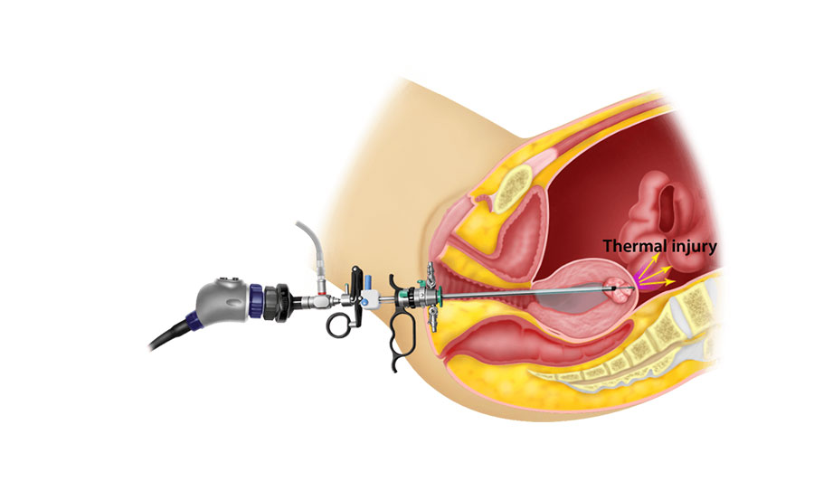 Hysteroscopy Procedure - Miracle IVF Hospital.
