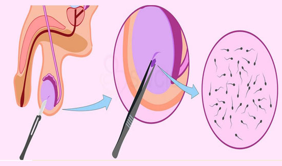PESA and TESA Procedures in Bangalore at Miracle Ivf Hospital 